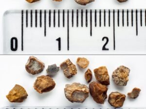 Tratamento para Pedra nos Rins em Curitiba